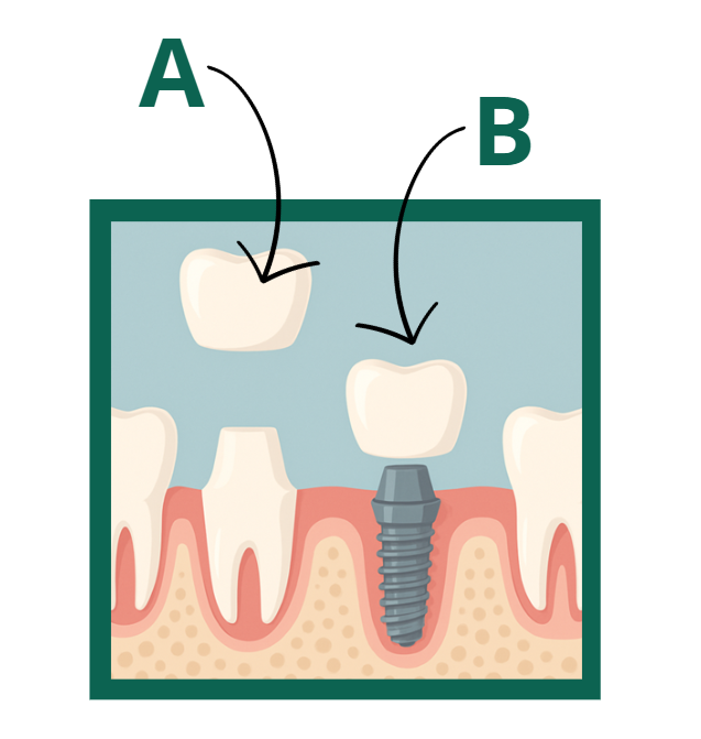 Protesi fissa su dente naturale e su impianto.